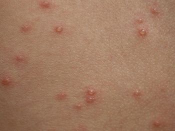 Alerta en la Ciudad: una mujer y un hombre murieron por sarampión y dengue