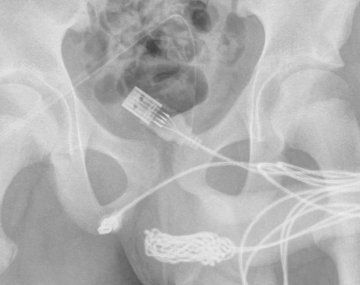 Se le atascó un cable USB en el pene: ¿qué tuvieron que hacer los médicos?