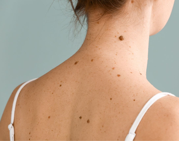 El test que revela cómo te ven los demás según la ubicación de los lunares