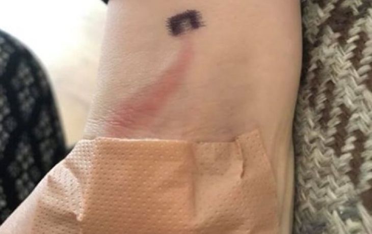 Vio una rara marca en su hijo y con su rápida reacción le salvó la vida