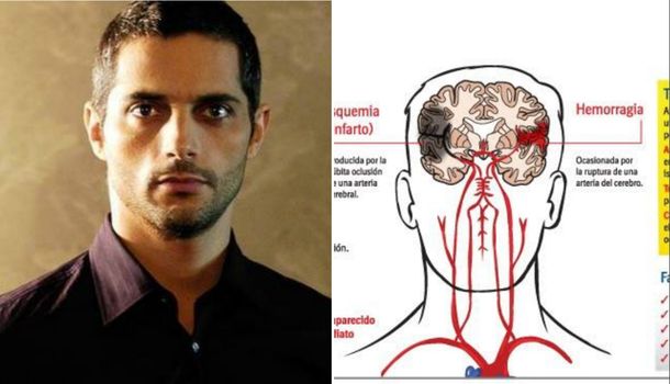 Salud: Qué es el infarto isquémico, la afección que tuvo Joaquín Furriel