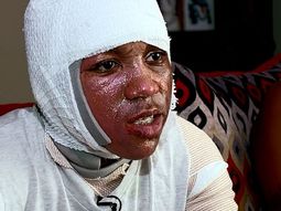 Por un desafío viral se tiró agua hirviendo y ahora tiene quemaduras de segundo grado