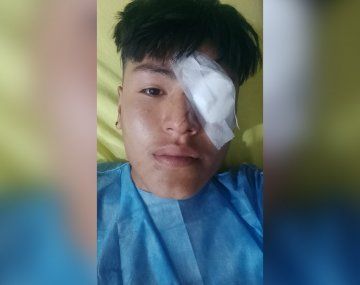 Represión en Jujuy: un joven perdió un ojo por las balas de goma
