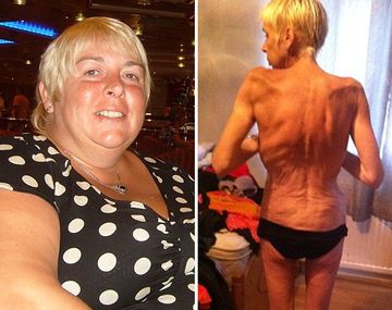 Denuncia que se volvió anoréxica por un by pass gástrico