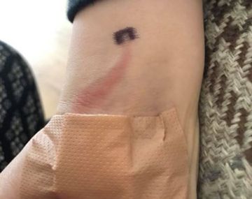 Vio una rara marca en su hijo y con su rápida reacción le salvó la vida