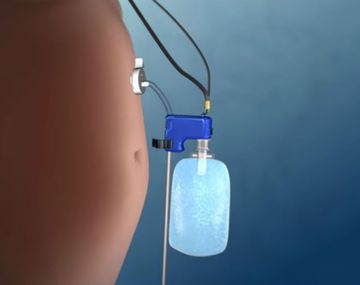 Aspirar la comida ya ingerida para adelgazar