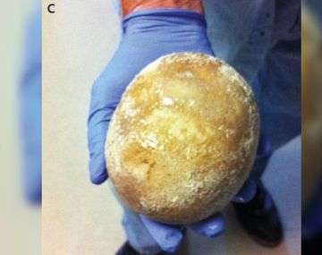 La piedra de la vejiga pesó casi un kilo