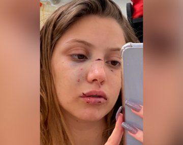 La confundieron con otra mujer y le pegaron con una frapera: sufrió múltiples fracturas en la cara y perdió dos dientes