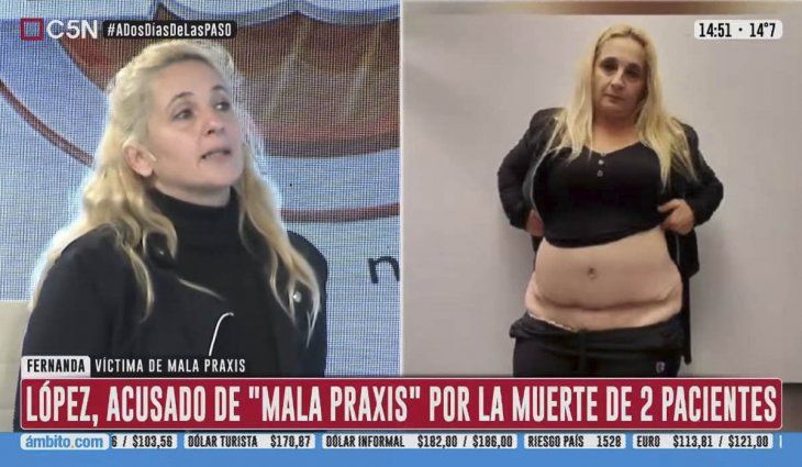 Una mujer denunció mala praxis de su cirujano plástico