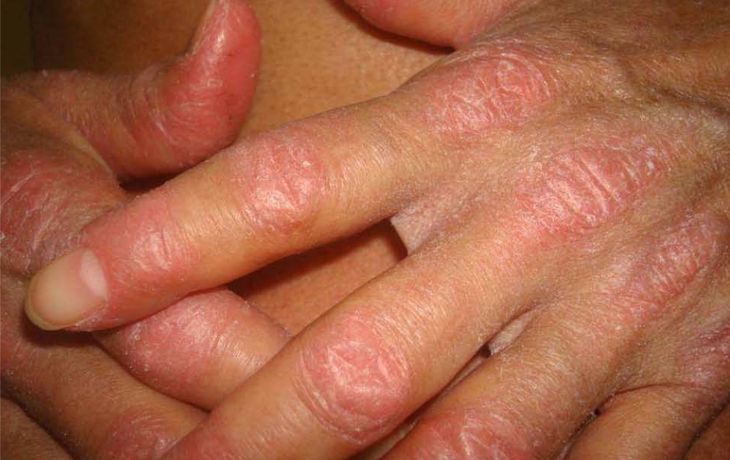 Lupus: la importancia de erradicar mitos