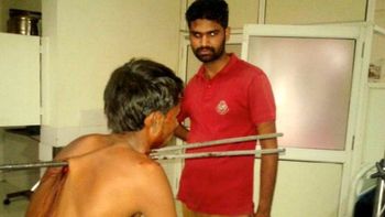 lo atravesaron dos barras de hierro y sobrevivio lo atravesaron dos barras de hierro y sobrevivio