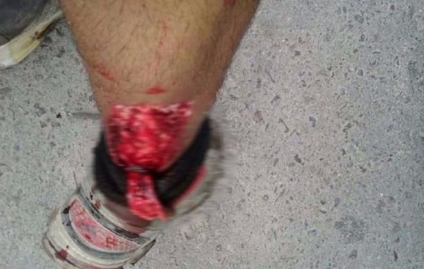 Un pitbull atacó a un recolector de basura en La Plata