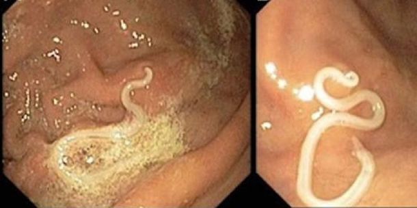 Las larvas del parásito Anisakis