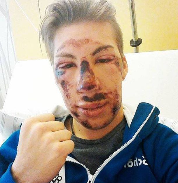 Impresionante: así quedó un esquiador tras esta escalofriante caída