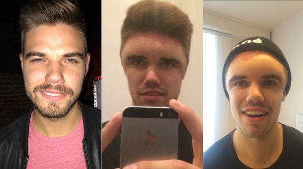 Tuvo una fuerte reacción a la tintura para pelo