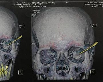 La radiografía muestra el lugar donde estaba alojado el cuchillo