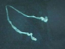 Un hombre sobrevive con un gusano de 15 cm en la cabeza