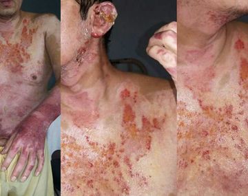 Su pareja lo roció con alcohol y lo quemó - Crédito: policialesdejujuy.com.ar