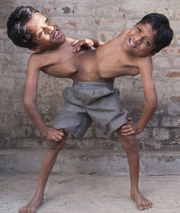 Son siameses y se niegan a ser separados porque en su país los adoran como dioses