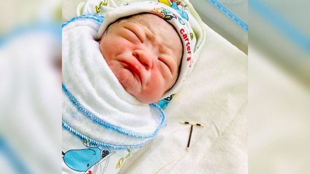 Viral: un beb&eacute; naci&oacute; en Vietnam con el DIU de su madre en la mano