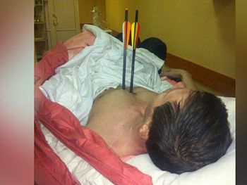 Un hombre se clavó dos flechas en su cuerpo y sobrevivió.&nbsp;