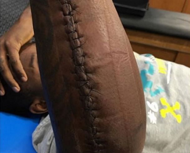 Impresionante: jugó el Super Bowl con el brazo quebrado