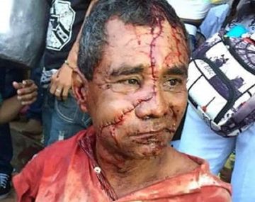 Un hombre recibió 50 puntos de sutura en su rostro después de ser atacado por un toro