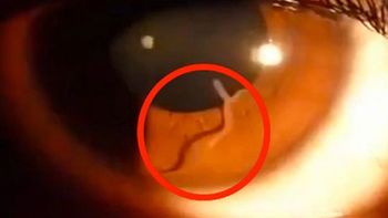 video: mira el gusano que tenia una mujer dentro de su ojo video: mira el gusano que tenia una mujer dentro de su ojo