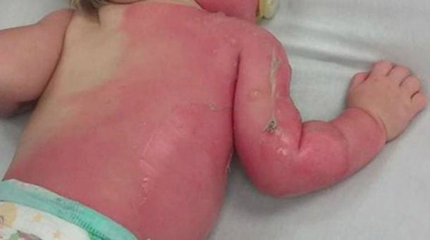 Un bebé sufrió quemaduras porque su mamá lo roció con agua hirviendo