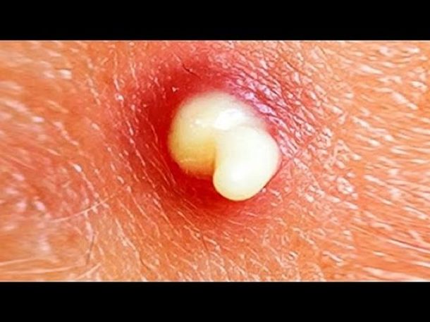 ¿Qué sucede si explotas tus granitos?