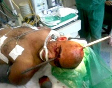 Sobrevivió a una perforación de cráneo con una barra de acero