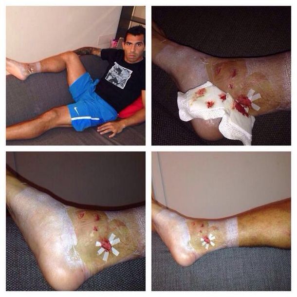 La indignación de Tevez por la brutal patada que le dejó así el tobillo