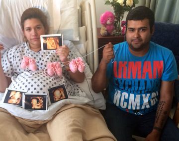 Nacieron trillizas idénticas y dos son siamesas