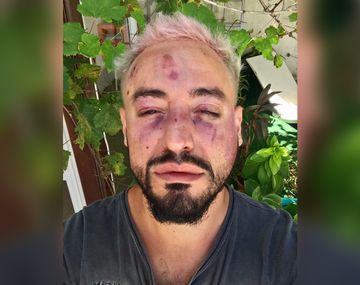 Franco Ruiz, víctima de un ataque homofóbico en Chaco