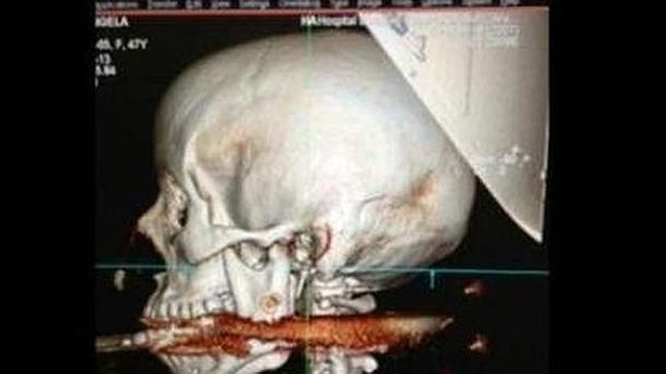 Brasil: un arpón le atravesó la garganta y sobrevivió