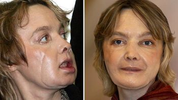 Isabelle Dinoire Isabelle Dinoire