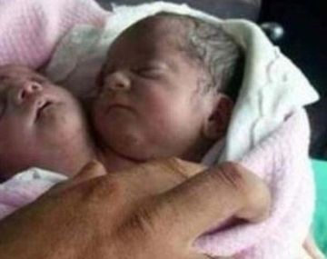 Nació un bebé con dos cabezas en Siria