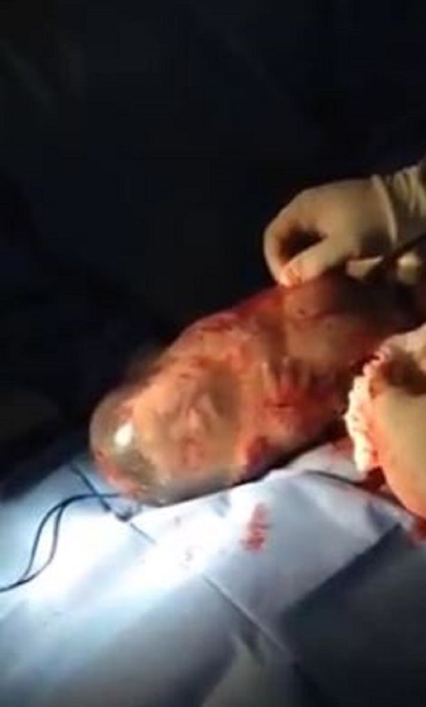 VIDEO: Mirá el bebé que bosteza dentro del saco amniótico