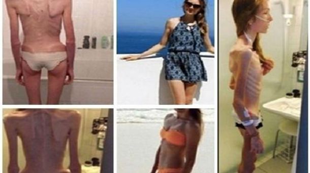 La joven llegó a pesar 31 kilos.
