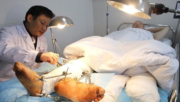 Cirujanos le dan dos pies derechos a un hombre para mantener viva la extremidad amputada