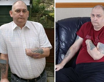 Un hombre guillotinó su mano porque los médicos no se la querían amputar