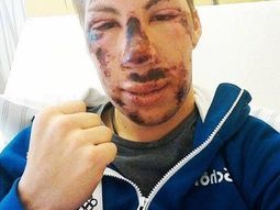 impresionante: asi quedo un esquiador tras esta escalofriante caida impresionante: asi quedo un esquiador tras esta escalofriante caida