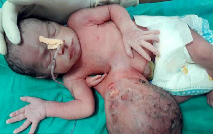 Además de una cabeza en el abdomen, la bebé tenía una tercera mano