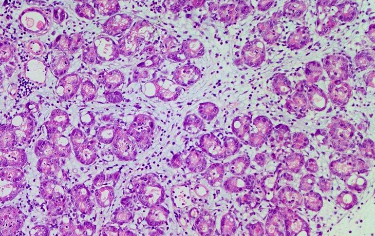 Descubren la molécula que limita el desarrollo del cáncer de páncreas