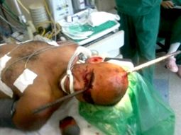 sobrevivio a una perforacion de craneo con una barra de acero sobrevivio a una perforacion de craneo con una barra de acero