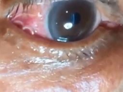 Asqueroso: le creció un gusano en el ojo por la picadura de un mosquito
