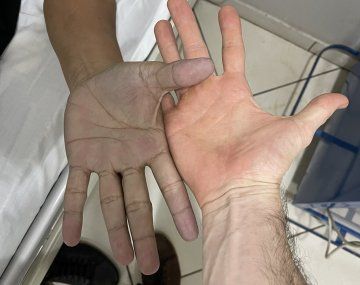 Médico recibe a paciente con manos azules y el diagnóstico sorprende a todos