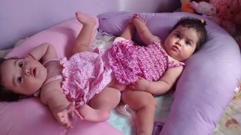 ¿como esta la siamesa que sobrevivio a la separacion hecha en el posadas? ¿como esta la siamesa que sobrevivio a la separacion hecha en el posadas?