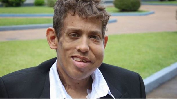 Murió Christian Fritz, el único argentino con la enfermedad del hombre elefante