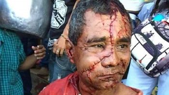 Un hombre recibió 50 puntos de sutura en su rostro después de ser atacado por un toro Un hombre recibió 50 puntos de sutura en su rostro después de ser atacado por un toro